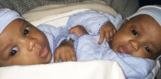 GUINÉE/ LES BÉBÉS SIAMOIS : UNE AUTRE ANOMALIE DÉTECTÉE !