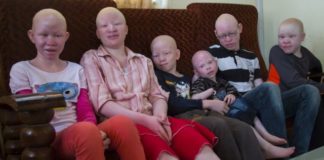 CANCER DE LA PEAU: LA COMMUNAUTÉ DES ALBINOS PRÉOCCUPÉE