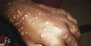 GUINEE/TELEDERMATOLOGIE : DES APPLICATIONS POUR SOIGNER A DISTANCE !