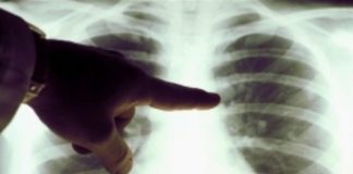 COVID-19/TUBERCULOSE: UNE PANDÉMIE AGGRAVE UNE AUTRE!