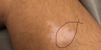 TACHES BLANCHES SUR LA PEAU: CAUSES, GRAVITÉ & TRAITEMENT