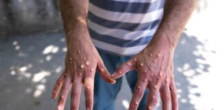 MPOX EN GUINÉE : MESURES ET PRÉPARATIONS DU GOUVERNEMENT