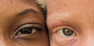 JOURNÉE MONDIALE DE L’ALBINISME: LES INSTITUTIONS S’IMPLIQUENT?