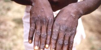 GUINÉE/MPOX : L’ANSS ALERTE SUR UNE RECRUDESCENCE DES CAS