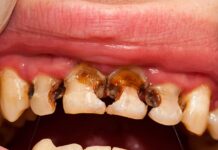 LA CARIE DENTAIRE, UNE MALADIE SILENCIEUSE QUI DÉTRUIT LES SOURIRES