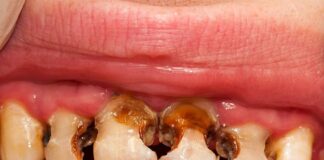 LA CARIE DENTAIRE, UNE MALADIE SILENCIEUSE QUI DÉTRUIT LES SOURIRES